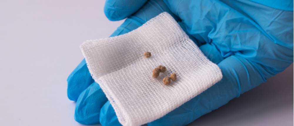 how do gall bladder stones develop know the treatment options